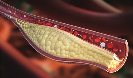 cholesterol-levels