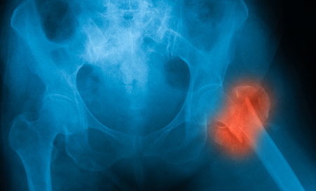 hip-fracture