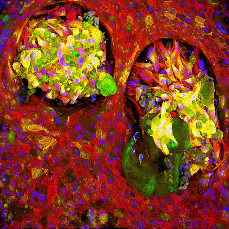 lung-cancer-cells