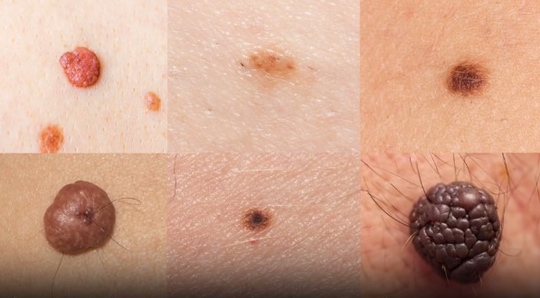 Some types of skin cancer might look like a simple mole or a skin rash 