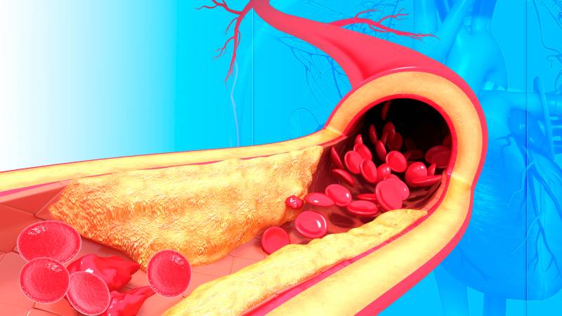 Single-cell immune profiling of human atherosclerosis