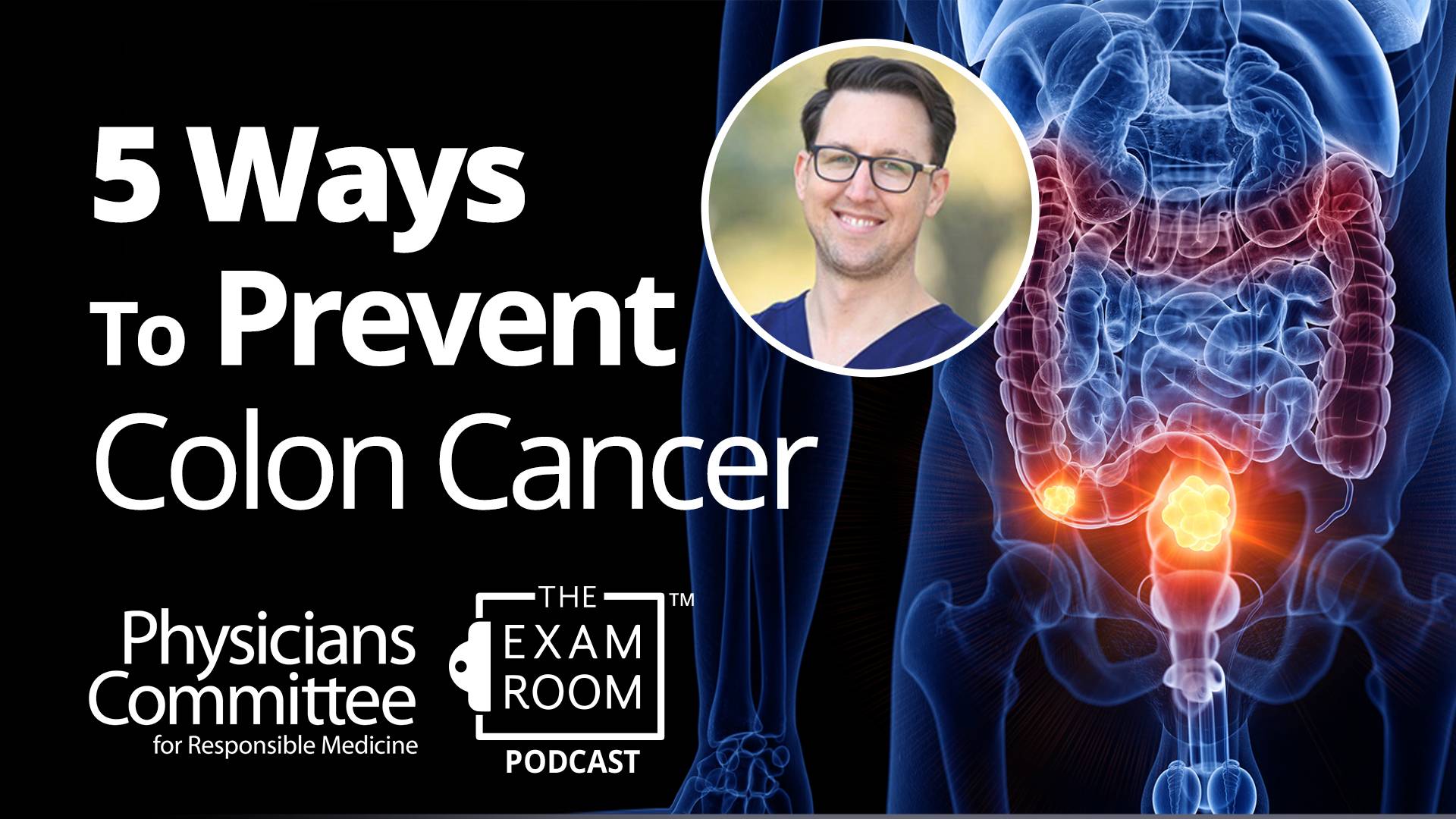 5 Ways to Prevent Colon Cancer