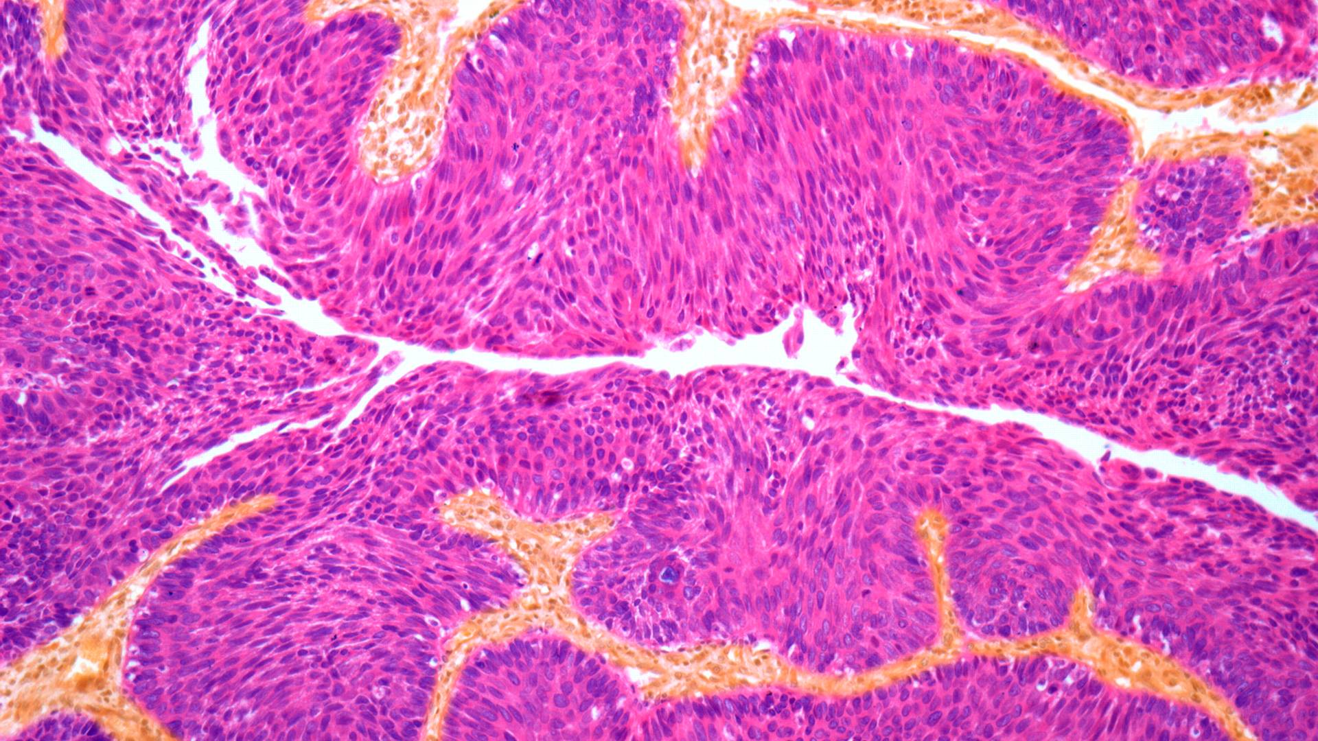 Bladder cancer, light micrograph